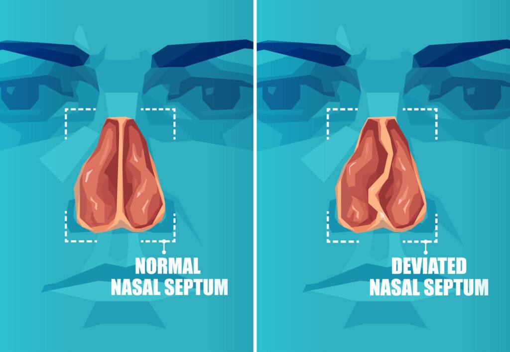 Septoplasty Biltmore ENT Sinus Phoenix AZ Biltmore Ent