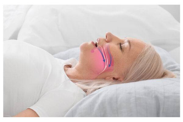 What are the 3 Types of Sleep Apnea? featured image