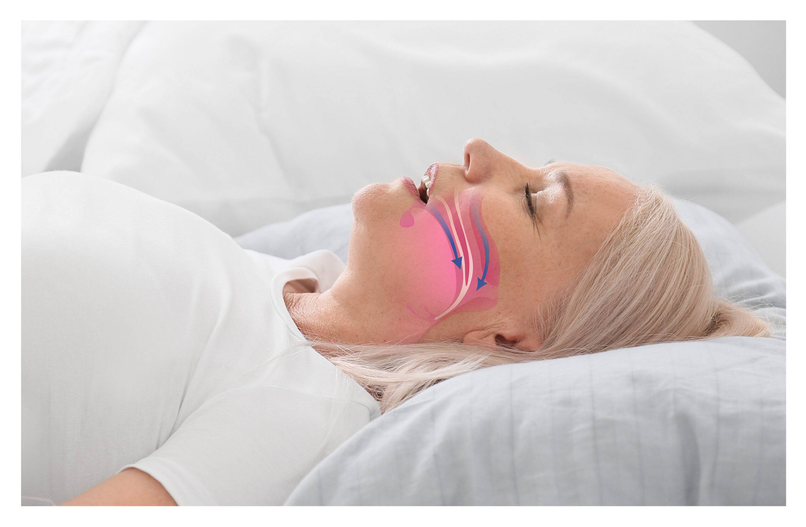 snoring treatment cave creek