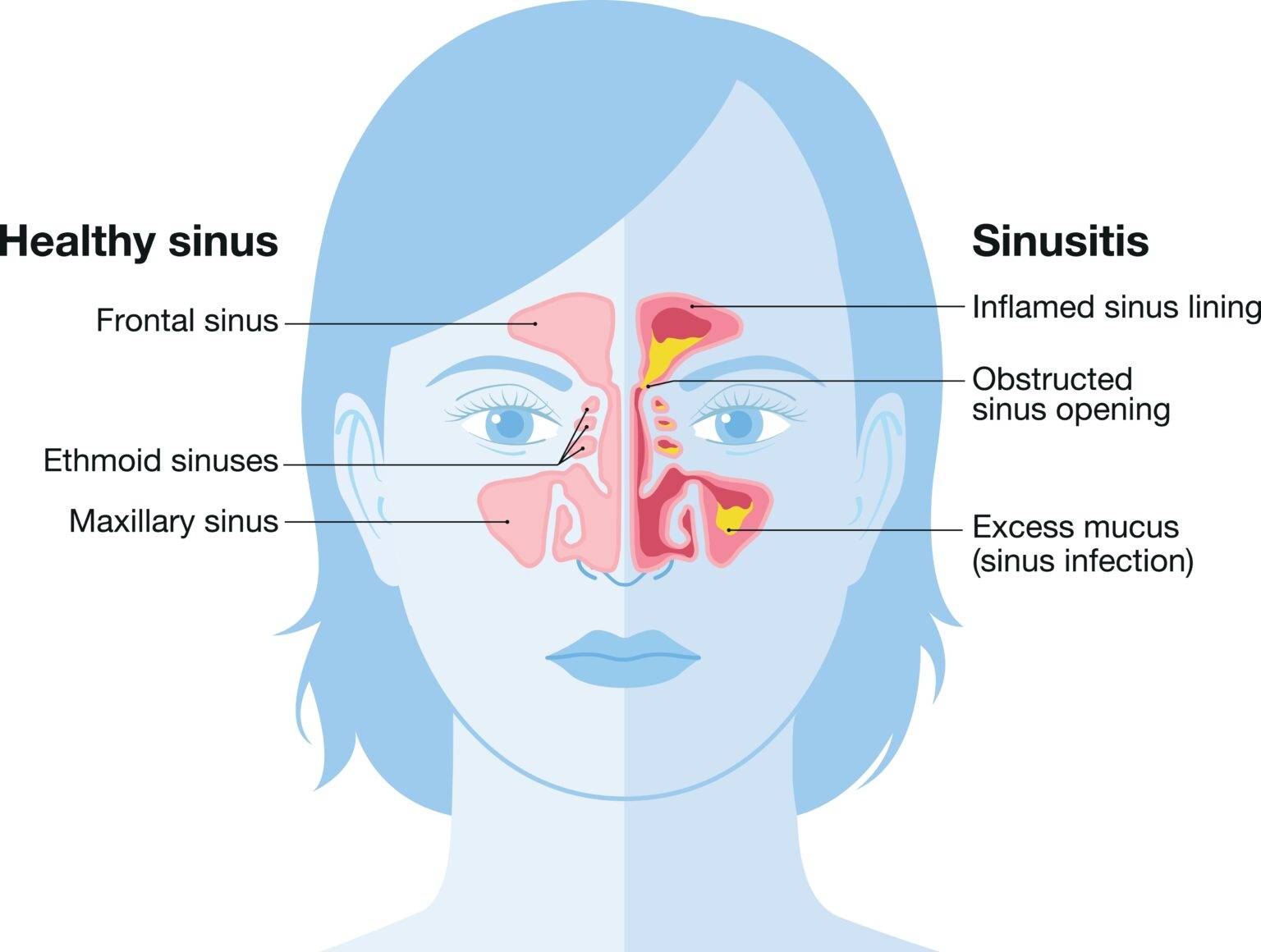 Can Blocked Sinuses Make You Feel Sick