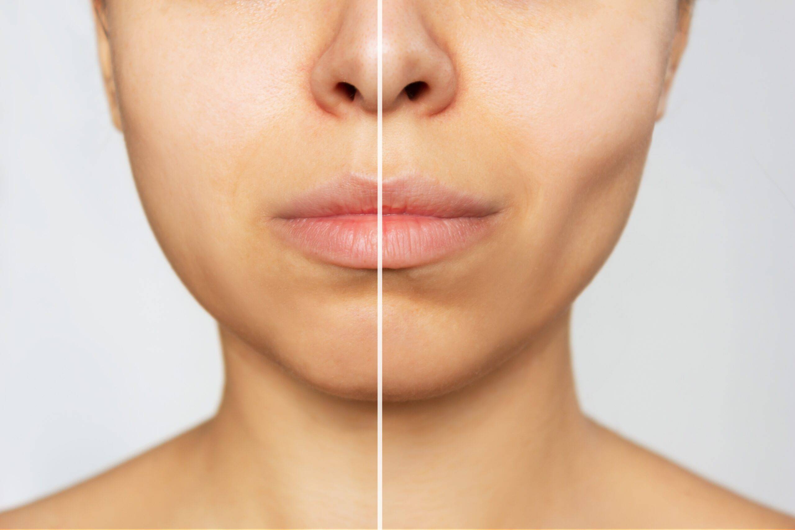 Buccal Fat Removal Biltmore ENT Cheek Fat Phoenix AZ Biltmore Ent